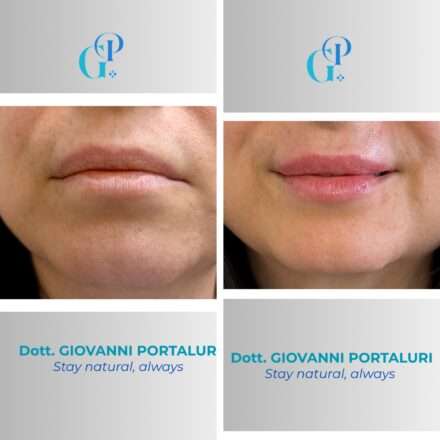 medico estetico esegue filler labbra per aumentare volume in modo naturale