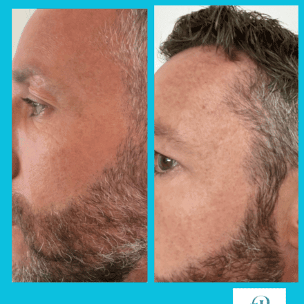 Trattamento viso con botox